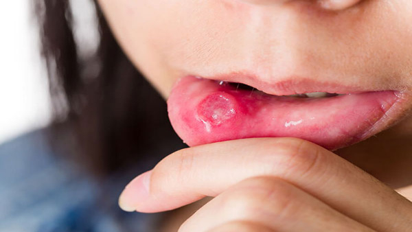 common foods that can trigger mouth ulcers in tamil 