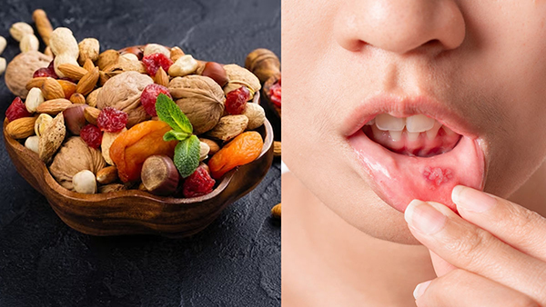 common foods that can trigger mouth ulcers in tamil 