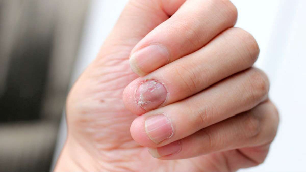 How to protect your nails from breaking in Tamil