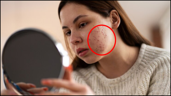 Skin Care Tips In Tamil: Simple Homemade Face Packs To Cure Acne Scars