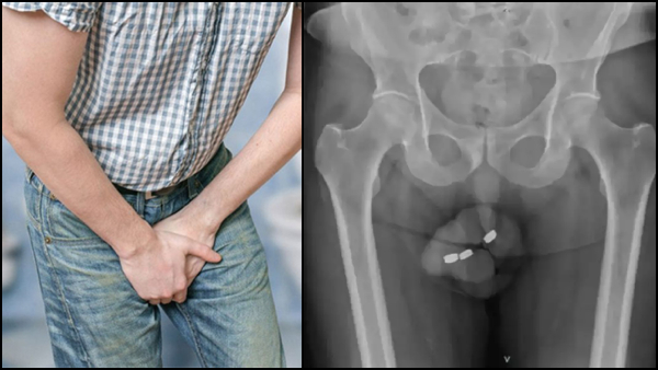 Australia Doctors Remove Batteries From Mans Private Part That Caused Severe Infection Australia Doctors Remove Batteries From Mans Private Part That Caused Severe Infection