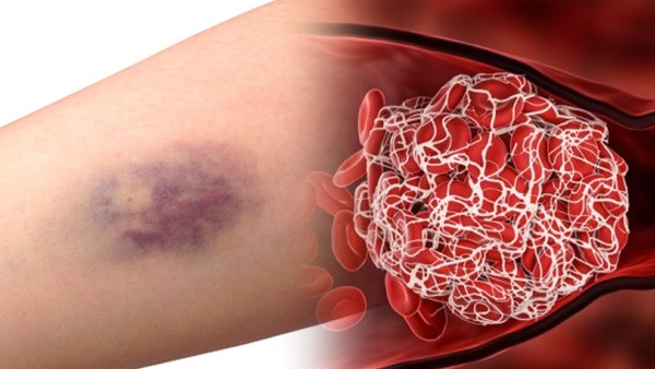 Blood clots: Why are they important and yet dangerous in tamil Blood clots: Why are they important and yet dangerous in tamil