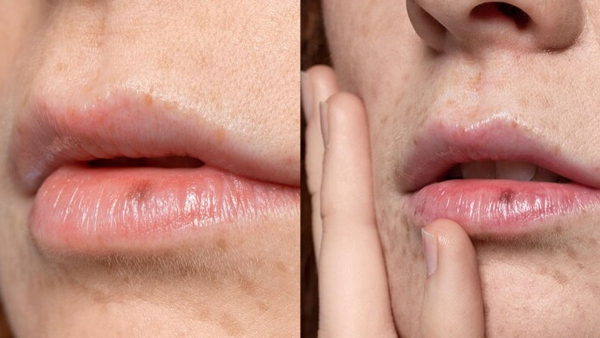 Common Causes of Black Spots on the Lips in Tamil