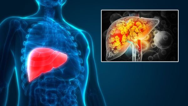Importance of early detection and lifestyle changes for liver conditions in tamil 