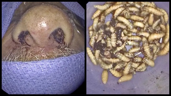 Florida Man Has 150 Live Bugs Removed From His Nose