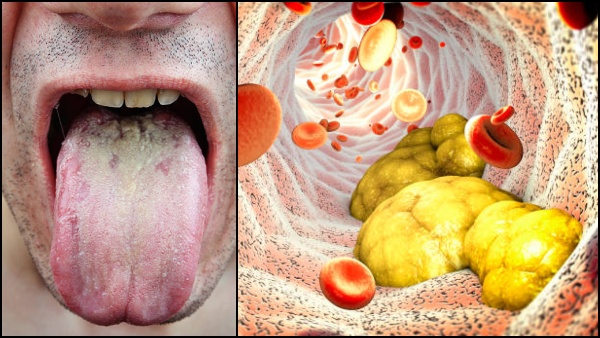 High Cholesterol Symptoms In Tamil: Unusual Signs Of High Cholesterol On The Tongue 