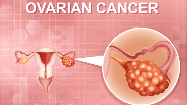 This simple urine test could detect ovarian cancer early, expert says