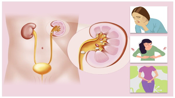 Tips to Detect Kidney Stones in Tamil