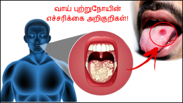 Mouth Cancer Symptoms In Tamil: Warning Signs Of Oral Cancer