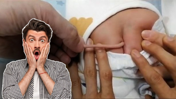 Baby born with four-inch tail growing from its back due to ultra rare birth defect