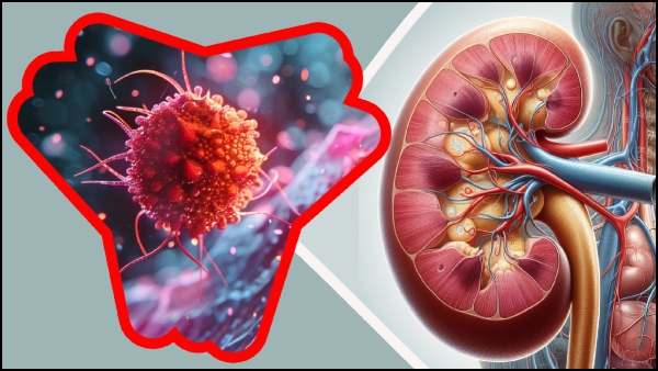 Kidney Cancer Symptoms In Tamil Early Signs Of Kidney Cancer You Must Know Kidney Cancer Symptoms In Tamil Early Signs Of Kidney Cancer You Must Know