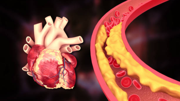 High Cholesterol Turmeric-Ginger Tea On Empty Stomach For High Cholesterol In Tamil