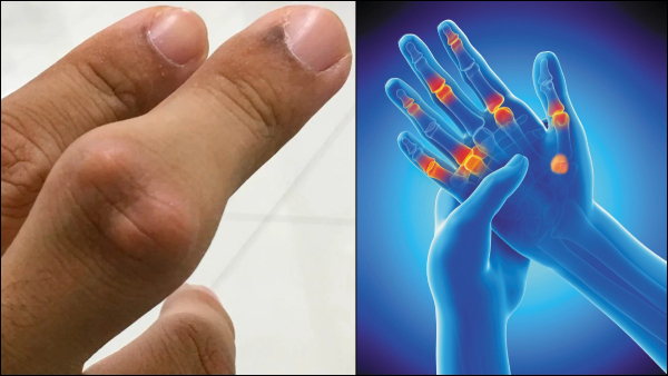 Unusual Symptoms Of High Uric Acid in Men in Tamil