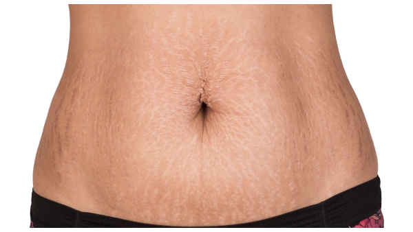 you must know about stretch marks removal food after pregnancy