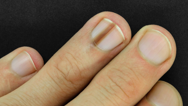 Black Line On Nails Beware Dark Vertical Line On Your Nails Could Be Cancer
