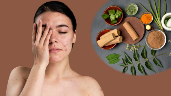 Summer Skin Care Tips In Tamil Top 5 Homemade Face Packs For Acne-prone Skin