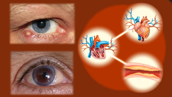High Cholesterol Symptoms Warning Signs Of High Cholesterol On Your Face And Eyes In Tamil