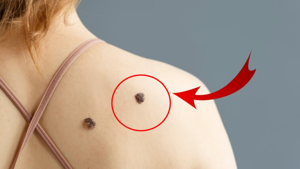 Skin Cancer Symptoms Top 6 Warning Signs Of Skin Cancer In Tamil