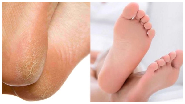 tips to cure cracked heels
