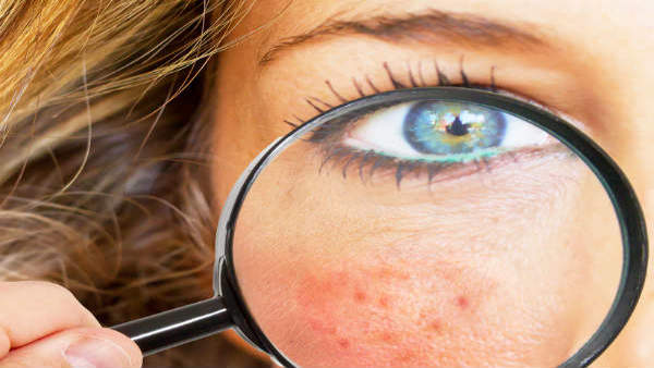 How High Blood Pressure Affects Skin Health in Tamil