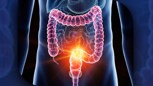 Colorectal Cancer These 2 Symptoms Occur In Nearly Half Of Early-Onset Colorectal Cancer Cases