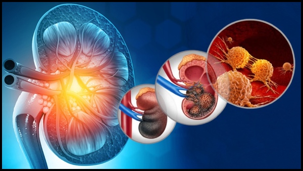 Kidney Cancer Top 5 Lifestyle Mistakes That Are Damaging Your Kidneys And Cause Cancer