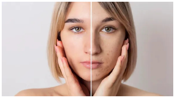 Smog Is Deteriorating Your Skin Here Are Some Tips To Keep Your Skin Safe