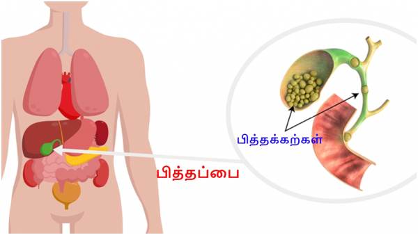Gallbladder Stone Symptoms Signs You Need a Gallbladder Removal Surgery In Tamil