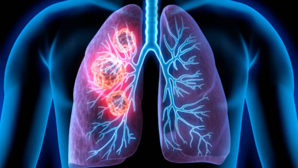 Lung Cancer Symptoms Top 4 Early Signs Of Lung Cancer In Men