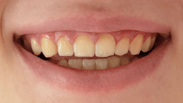 Causes for Yellow Teeth in Tamil