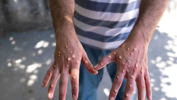 Mpox Virus What is Mpox and Why Is This Outbreak Dangerous