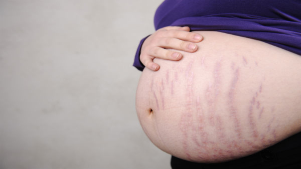 Common Skin Problems Women Face During Pregnancy