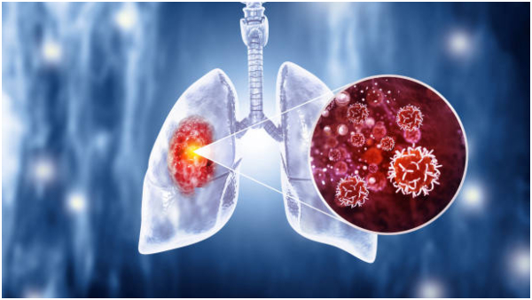 World Lung Cancer Day 2024 Warning Signs Of Lung Cancer Visible On Your Face