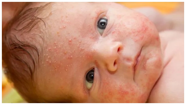 common skin problems affected to babies