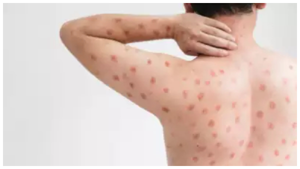 india-found-first-mpox-clade-1b-case-in-malappuram