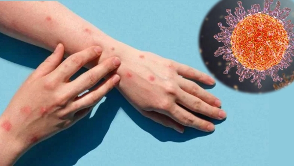 Monkeypox Doctor explains Whether Monkeypox Be A Threat To India