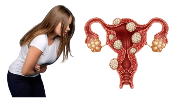 Working Women Have More Chances Of Getting Uterine Fibroids Tips To Prevent It