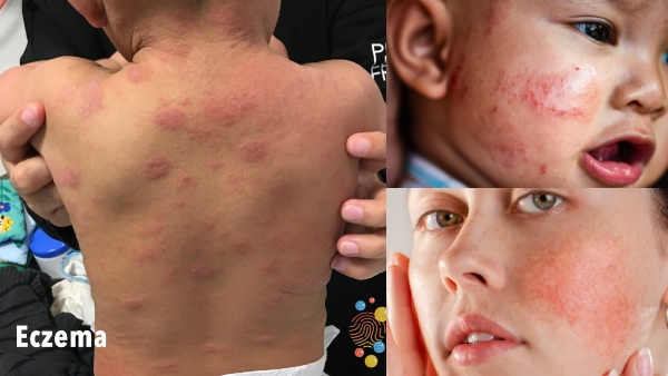 what-is-eczema-how-to-prevent-kids-from-this-skin-problems-dermatology-dr-priyadharshini-explained