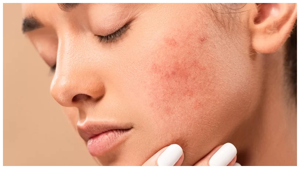 what is eczema how to prevent kids from this skin problems dermatology dr priyadharshini explained