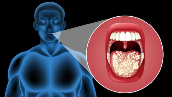 Exclusive Rising Mouth Cancer Rates In India Expert Shares The Causes Of Oral Cancer And Its Signs