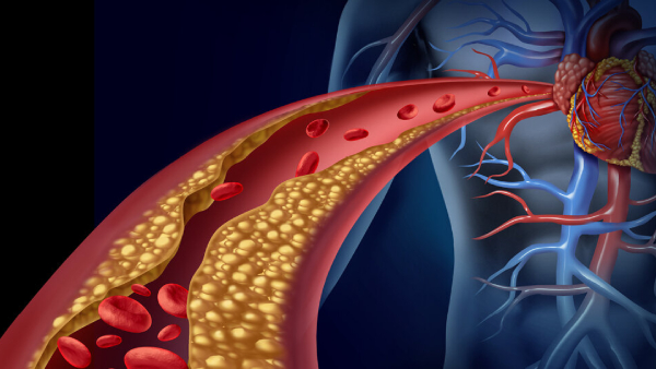 High Cholesterol Lowering Diet Tips 5 Juices You Must Drink After Lunch To Reduce Bad Cholesterol