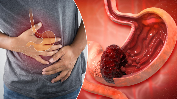 Cancer Can Eating Too Much Salt Cause Stomach Cancer