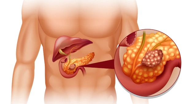 Pancreatic Cancer Symptoms Early Warning Signs of Pancreatic Cancer In Tamil