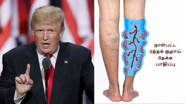Doctor Explains About Chronic Venous Insufficiency Which Donald Trump Has Been Diagnosed With