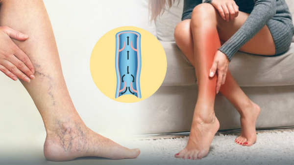 Doctor Explains About Chronic Venous Insufficiency Which Donald Trump Has Been Diagnosed With