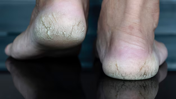 Top 5 DIY Natural Remedies For Cracked Heels
