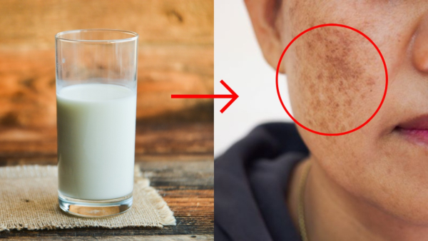 Skin Care Tips Top 5 DIY Natural Remedies To Reduce Hyperpigmentation