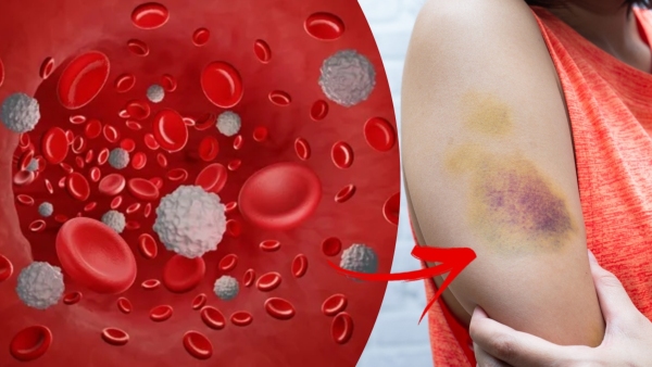 Leukemia Awareness Month Doctor Shares Symptoms Of Leukemia That Should Never Be Ignored