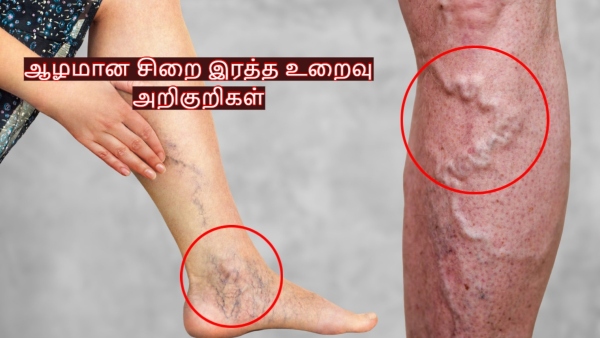 World Thrombosis Day 2025 Vascular Surgeon Explains About Deep Vein Thrombosis DVT