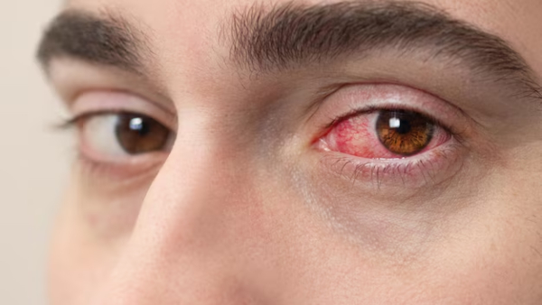 World Sight Day 2025 Ophthalmologist Lists Top 5 Warning Signs of Serious Eye Problems